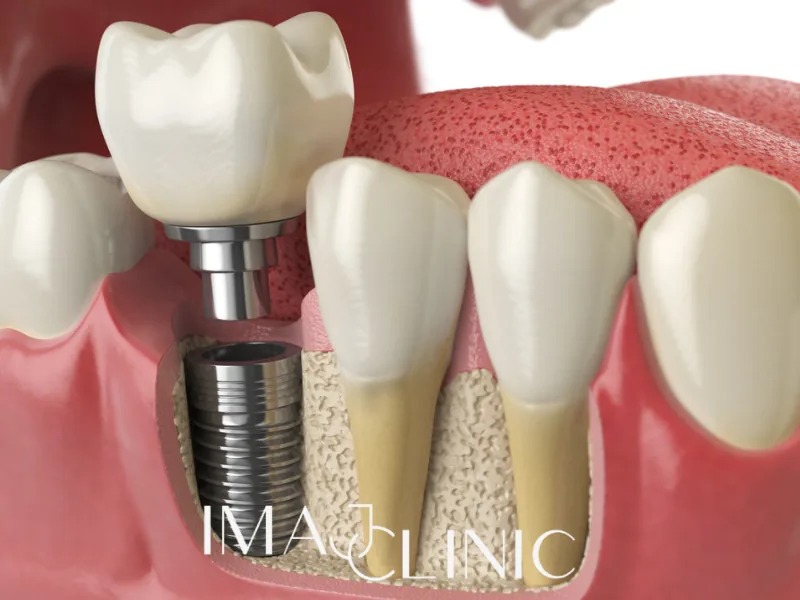 Dental İmplant